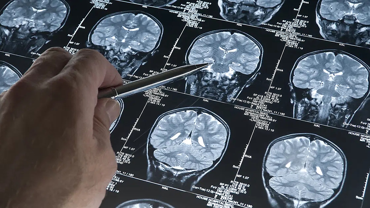 Alzheimer'da gençlik proteini keşfi
